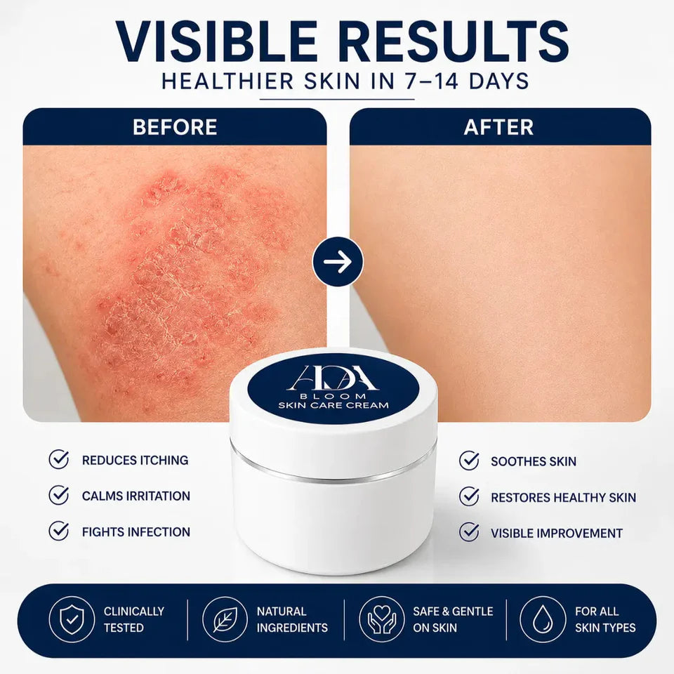 ADA Bloom Skin Relief Cream - For Fungal Infection, Psoriasis, Eczema